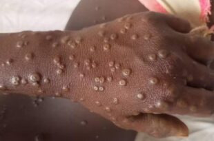 Variole du singe MPOX